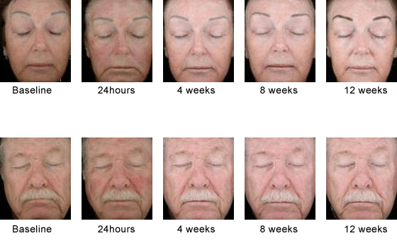 Levulan for Skin Cancer/Acne