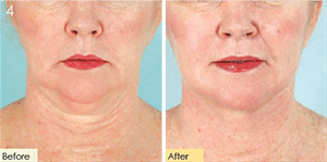 1747780834_Thread-Lift-Threadlift-01 Thread Lift/ Ribbon Lift