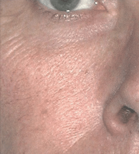 1747781017_BeforeAfter_04_Before Laser Skin Rejuvenation