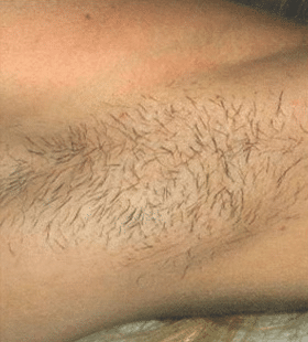 1747781355_BeforeAfter_15_Before Laser Hair Removal