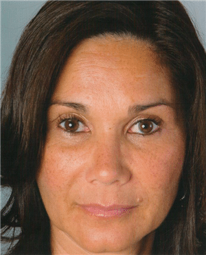 1747781664_Artefill-01 Bellafill