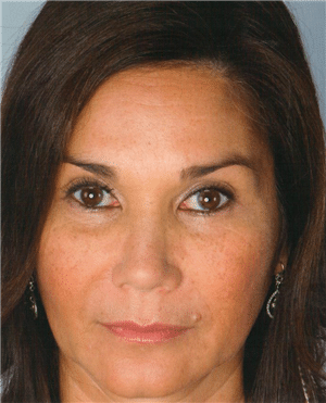 1747781669_Artefill-01a Bellafill