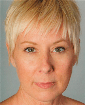 1747781673_Artefill-02 Bellafill