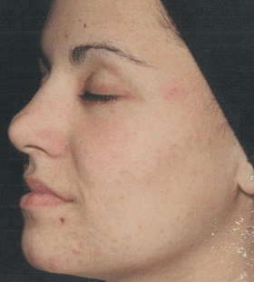 After Image: Acne Reduction - left-front-oblique
