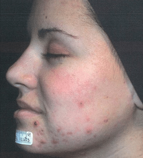 Before Image: Acne Reduction - left-front-oblique