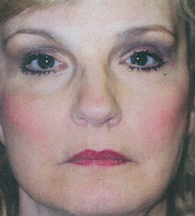 After Image: Endotine Ribbon - front