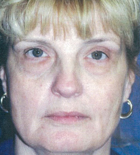 Before Image: Endotine Ribbon - front