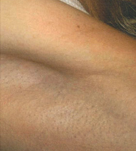 After Image: Laser Hair Removal - front