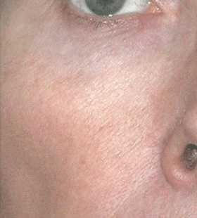 After Image: Laser Skin Rejuvenation - right-front-oblique