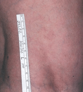 After Image: Leg Vein Treatment - front