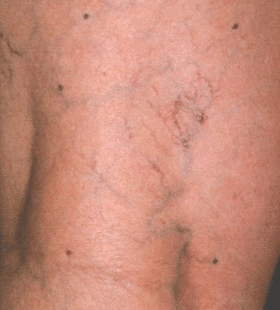 Before Image: Leg Vein Treatment - front