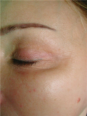 After Image: Pelleve - left-front-oblique