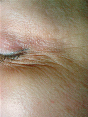 Before Image: Pelleve - left-front-oblique