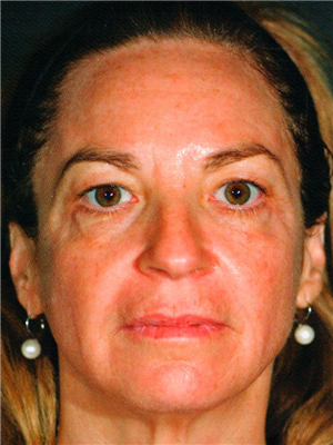 After Image: Pelleve - front