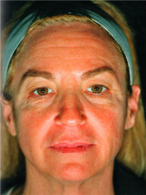 Before Image: Pelleve - front