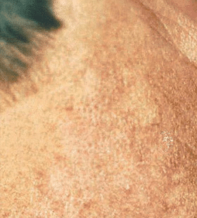 After Image: Port Wine Stain Treatment - front