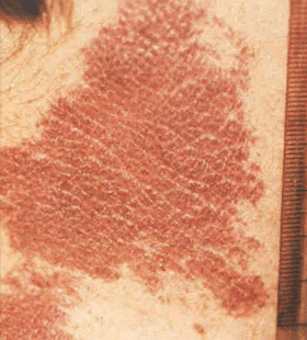 Before Image: Port Wine Stain Treatment - front