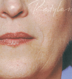 After Image: Restylane - front