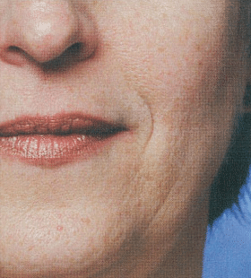 Before Image: Restylane - front