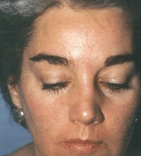 After Image: Rosacea Treatment - front