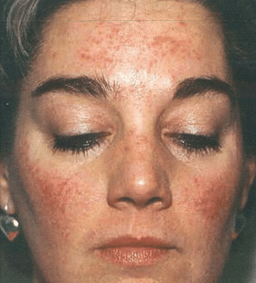 Before Image: Rosacea Treatment - front