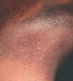 After Image: Shaving Bump Treatment - right-front-oblique