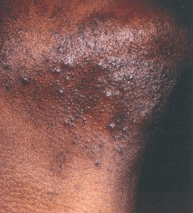 Before Image: Shaving Bump Treatment - right-front-oblique