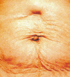 After Image: Skin Tightening - front