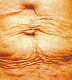 Before Image: Skin Tightening - front