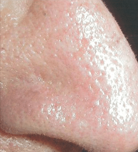 After Image: Small Facial Vein Treatment - right-side