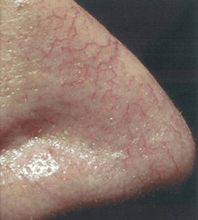 Before Image: Small Facial Vein Treatment - right-side