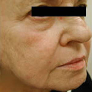 After Image: BOTOX - right-front-oblique
