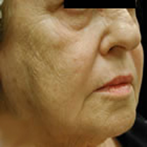 Before Image: BOTOX - right-front-oblique