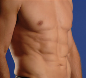 After Image: Smartlipo - right-front-oblique
