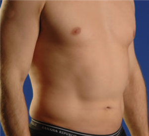 Before Image: Smartlipo - right-front-oblique