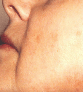 After Image: Sun Damage Treatment - left-side