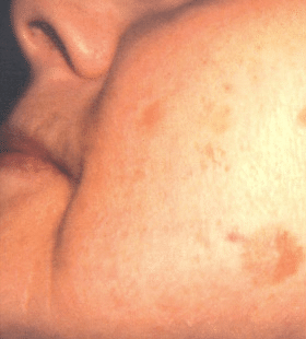 Before Image: Sun Damage Treatment - left-side