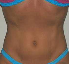 After Image: Vaserlipo - front