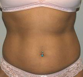 Before Image: Vaserlipo - front