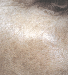 After Image: Wrinkle Reduction – Collagen Stimulation - right-front-oblique