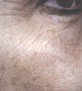 Before Image: Wrinkle Reduction – Collagen Stimulation - right-front-oblique