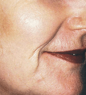 After Image: Wrinkle Reduction – Laser Resurfacing - right-front-oblique