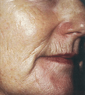 Before Image: Wrinkle Reduction – Laser Resurfacing - right-front-oblique