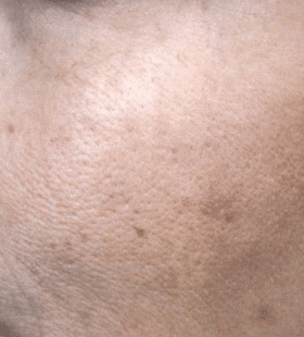 After Image: Wrinkle Reduction – Mini Weekend Peel - left-front-oblique