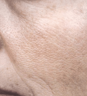 Before Image: Wrinkle Reduction – Mini Weekend Peel - left-front-oblique